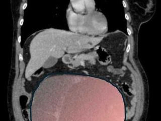 Miracolo al Sant'Anna: salvata 69enne affetta da un tumore ovarico grande come una gravidanza gemellare