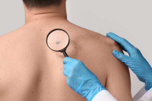 Giornata Europea del Melanoma: le linee guida per la prevenzione Giornata Europea del Melanoma: le linee guida per la prevenzione