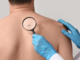 Giornata Europea del Melanoma: le linee guida per la prevenzione