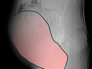 Miracolo al Sant'Anna: salvata 69enne affetta da un tumore ovarico grande come una gravidanza gemellare Miracolo al Sant'Anna: salvata 69enne affetta da un tumore ovarico grande come una gravidanza gemellare