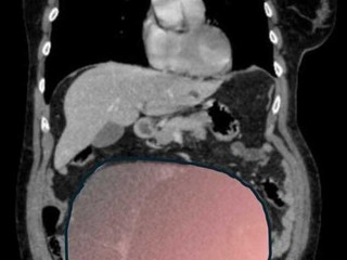 Miracolo al Sant'Anna: salvata 69enne affetta da un tumore ovarico grande come una gravidanza gemellare Miracolo al Sant'Anna: salvata 69enne affetta da un tumore ovarico grande come una gravidanza gemellare