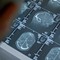 Fenilchetonuria, 'screening neonatale evita danni neurologici ma serve continuità assistenziale'