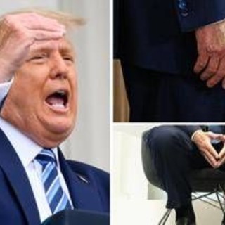 Trump e le gambe gonfie, cos'è l'insufficienza venosa cronica
