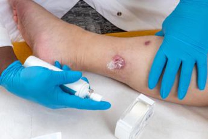 Idrosadenite suppurativa, le iniziative di Ucb per migliorare diagnosi e cura Idrosadenite suppurativa, le iniziative di Ucb per migliorare diagnosi e cura