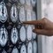 Centro Dbs Pavia, 100 interventi di neurostimolazione profonda per Parkinson Centro Dbs Pavia, 100 interventi di neurostimolazione profonda per Parkinson