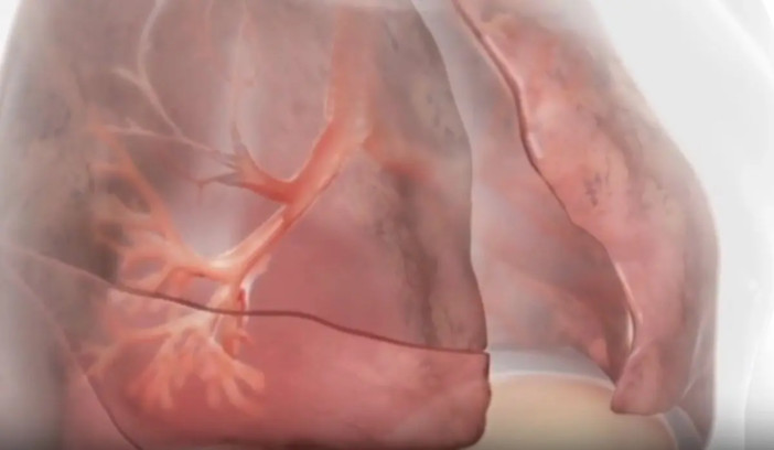 Innovazioni terapeutiche nella BPCO con enfisema