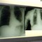 Cancro polmone a piccole cellule, ok Ue a tislelizumab