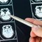 Intelligenza Artificiale può prevedere evoluzione Parkinson, lo studio italiano