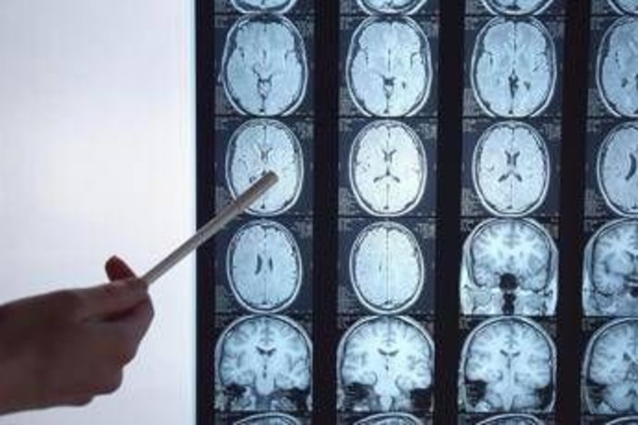 Di Battista e il tumore al cervello, in Italia circa 6mila diagnosi ogni anno: quali sono i sintomi 'spia'