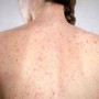 Morbillo, l'allarme dell'infettivologo Andreoni: "Casi in crescita, ricoveri frequenti negli adulti"