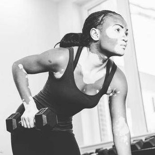 Vitiligine, "così la terapia della luce aiuta il farmaco" Vitiligine, "così la terapia della luce aiuta il farmaco"