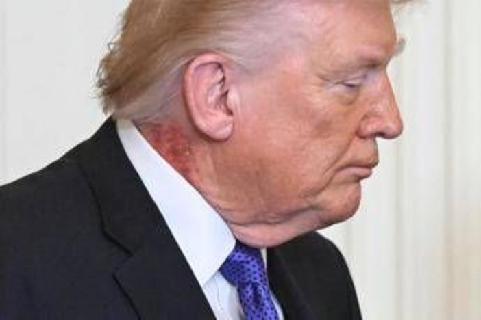 Trump e il collo arrossato, la foto riaccende i dubbi sulla salute del presidente