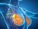Cancro seno iniziale Her2+, con anticorpo farmaco-coniugato -53% recidiva