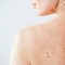 Nei e sole, Sidemast lancia la Giornata della prevenzione dermatologica