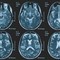 Una persona su 3 ha un disturbo neurologico, a Napoli arriva BrainSpace House Una persona su 3 ha un disturbo neurologico, a Napoli arriva BrainSpace House