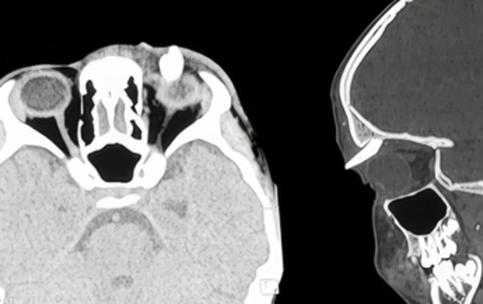 Ha un gonfiore sotto l'occhio, in ospedale scoprono che ha un dente nella palpebra: lo strano caso in India