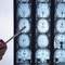 Di Battista e il tumore al cervello, in Italia circa 6mila diagnosi ogni anno: quali sono i sintomi 'spia' Di Battista e il tumore al cervello, in Italia circa 6mila diagnosi ogni anno: quali sono i sintomi 'spia'
