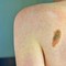 Melanoma, la firma mutazionale del cancro potrà cambiare la cura Melanoma, la firma mutazionale del cancro potrà cambiare la cura