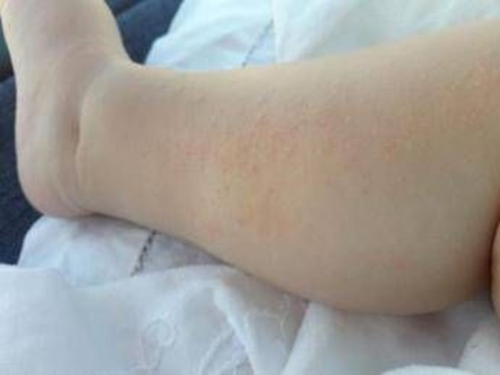 Dermatite atopica, Aifa estende rimborso di upadacitinib dai 12 anni di età Dermatite atopica, Aifa estende rimborso di upadacitinib dai 12 anni di età