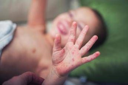 Morbillo, aumentano casi e ricoveri. Bassetti: "In Liguria focolaio senza precedenti, l'Italia rischia gravissima epidemia" Morbillo, aumentano casi e ricoveri. Bassetti: "In Liguria focolaio senza precedenti, l'Italia rischia gravissima epidemia"