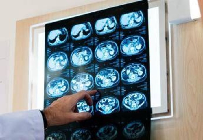 Nodulo polmonare: che cos’è, come si diagnostica e quando intervenire Nodulo polmonare: che cos’è, come si diagnostica e quando intervenire