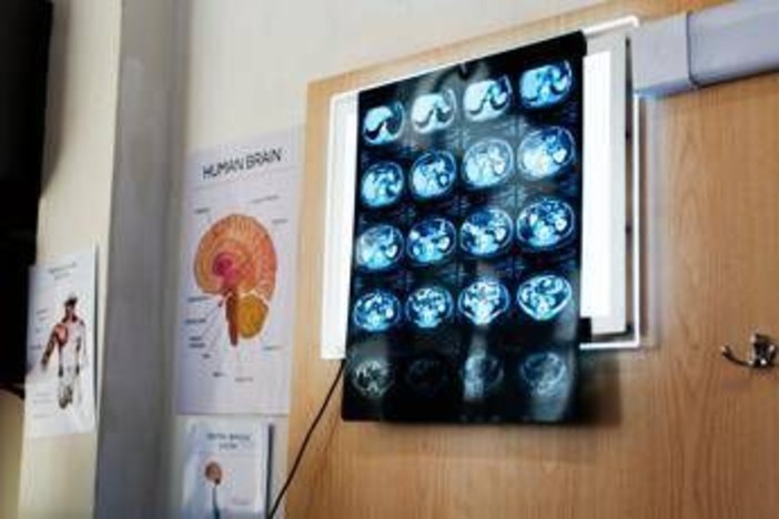 Di Battista, cosa indica un mal di testa forte e improvviso: le ipotesi del neurologo