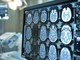 Neoplasie cerebrali, in Italia ogni anno 3mila casi di glioma Neoplasie cerebrali, in Italia ogni anno 3mila casi di glioma